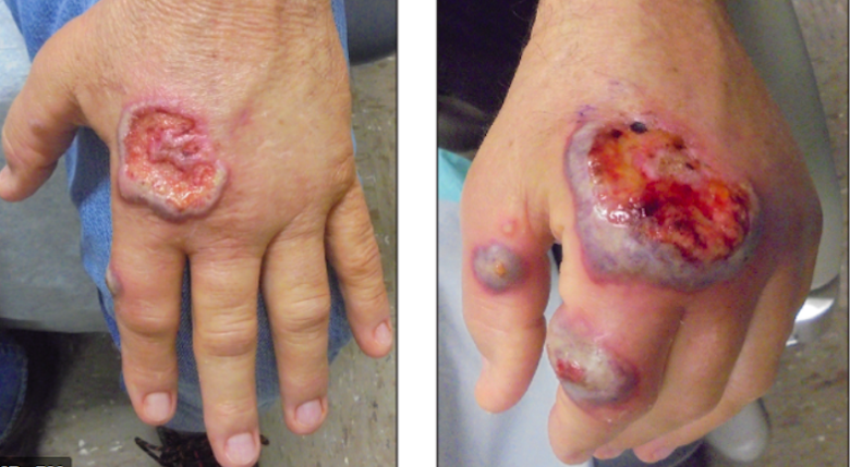 Tatuaggi moulage per la formazione simulata in 9 passaggi